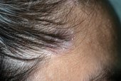 Fungal Hair Symptoms