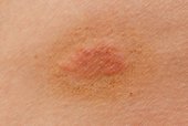 fungal infection skin skin areas symptoms