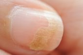 Nail fungus symptoms