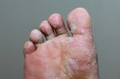 Foot fungus symptoms